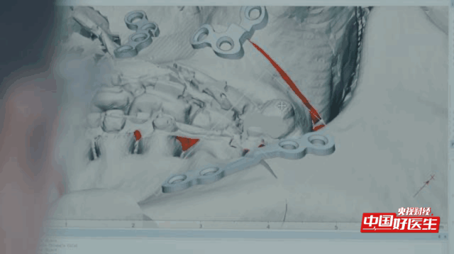 央视关注 3Dkaiyun官网打印出“接骨神器”(图5)