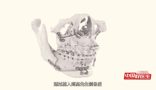 央视关注 3Dkaiyun官网打印出“接骨神器”(图6)